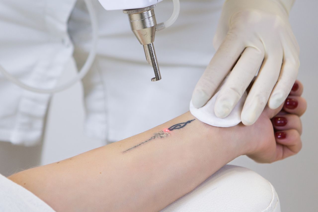 Usunięcie tatuażu za pomocą lasera – na czym polega?
